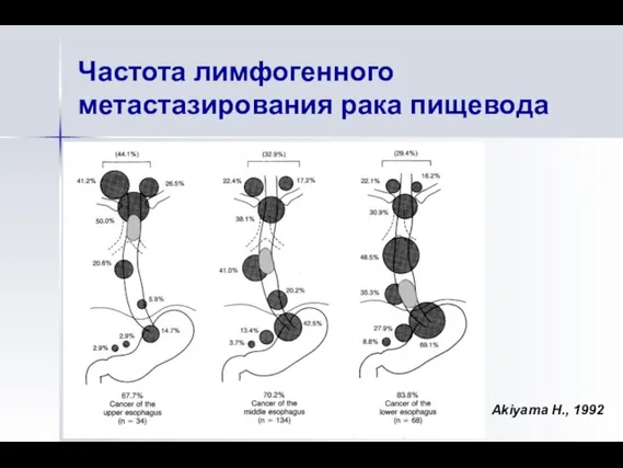 Частота лимфогенного метастазирования рака пищевода Akiyama H., 1992