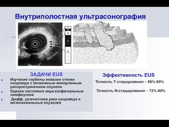 Внутриполостная ультрасонография ЗАДАЧИ ЕUS Изучение глубины инвазии стенки пищевода с возможным