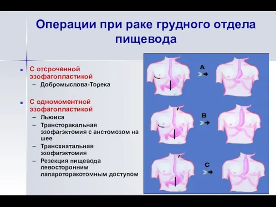 Операции при раке грудного отдела пищевода С отсроченной эзофагопластикой Добромыслова-Торека С