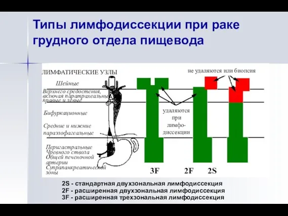 Типы лимфодиссекции при раке грудного отдела пищевода 2S - стандартная двухзональная