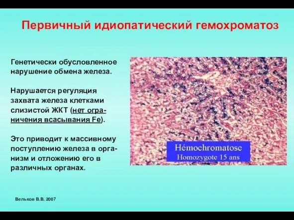 Первичный идиопатический гемохроматоз Генетически обусловленное нарушение обмена железа. Нарушается регуляция захвата