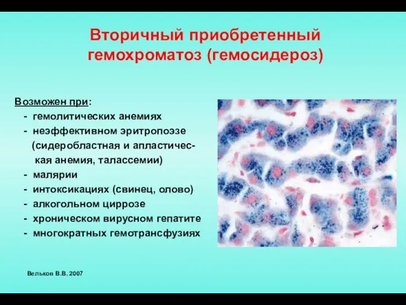 Вторичный приобретенный гемохроматоз (гемосидероз) Возможен при: - гемолитических анемиях - неэффективном