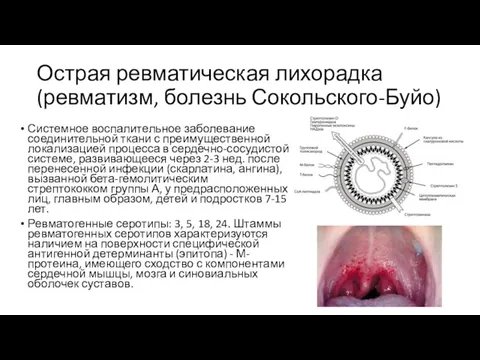 Острая ревматическая лихорадка (ревматизм, болезнь Сокольского-Буйо) Системное воспалительное заболевание соединительной ткани