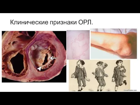 Клинические признаки ОРЛ.