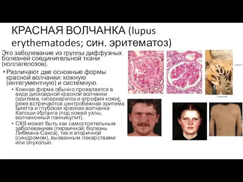 КРАСНАЯ ВОЛЧАНКА (lupus erythematodes; син. эритематоз) Это заболевание из группы диффузных