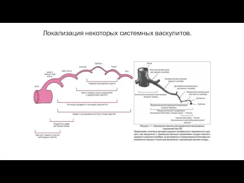 Локализация некоторых системных васкулитов.