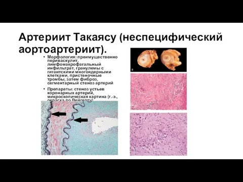 Артериит Такаясу (неспецифический аортоартериит). Морфология: преимущественно периваскулит, лимфомакрофагальный инфильтрат, гранулемы с