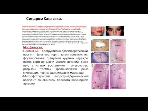 Синдром Кавасаки. Синдром Кавасаки (Т. Kawasaki, современный японский врач; острый детский