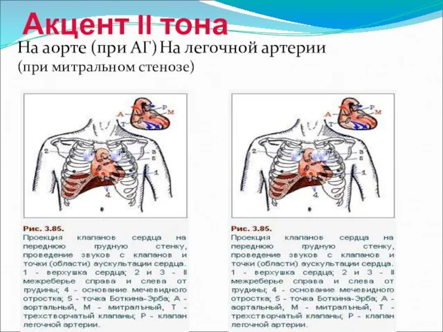 Акцент II тона На аорте (при АГ) На легочной артерии (при митральном стенозе)