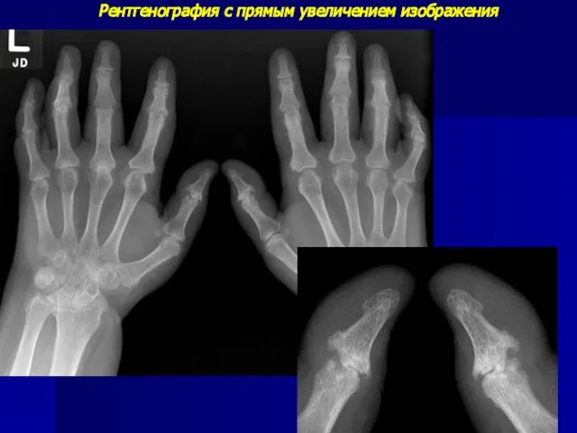 Рентгенография с прямым увеличением изображения