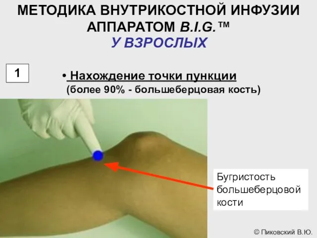 МЕТОДИКА ВНУТРИКОСТНОЙ ИНФУЗИИ АППАРАТОМ B.I.G.™ У ВЗРОСЛЫХ 1 Нахождение точки пункции