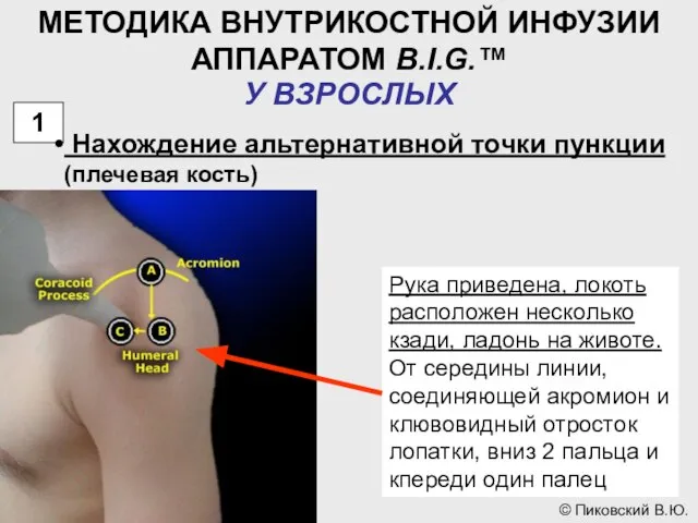 МЕТОДИКА ВНУТРИКОСТНОЙ ИНФУЗИИ АППАРАТОМ B.I.G.™ У ВЗРОСЛЫХ 1 Нахождение альтернативной точки