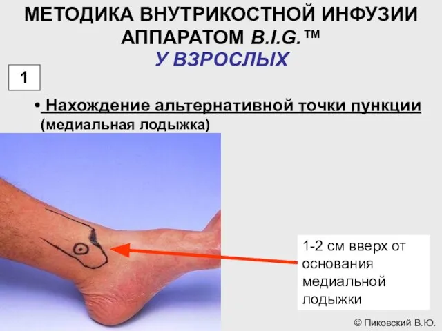 МЕТОДИКА ВНУТРИКОСТНОЙ ИНФУЗИИ АППАРАТОМ B.I.G.™ У ВЗРОСЛЫХ 1 Нахождение альтернативной точки