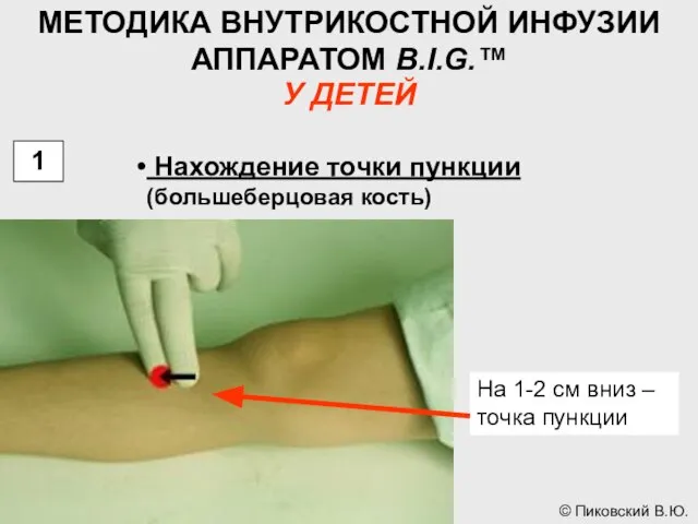 МЕТОДИКА ВНУТРИКОСТНОЙ ИНФУЗИИ АППАРАТОМ B.I.G.™ У ДЕТЕЙ 1 Нахождение точки пункции