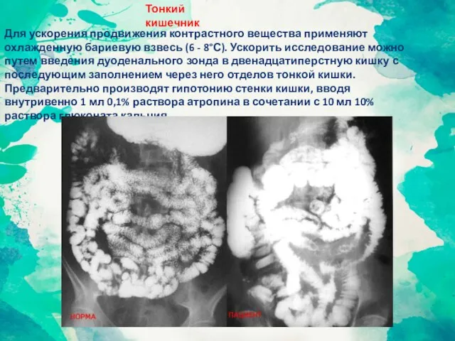 Тонкий кишечник Для ускорения продвижения контрастного вещества применяют охлажденную бариевую взвесь