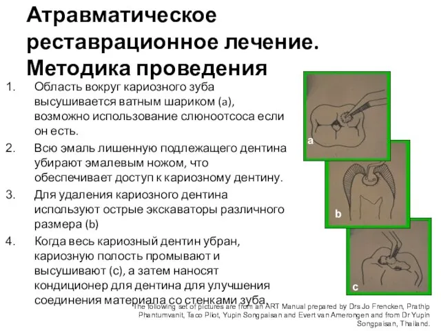 Атравматическое реставрационное лечение. Методика проведения Область вокруг кариозного зуба высушивается ватным