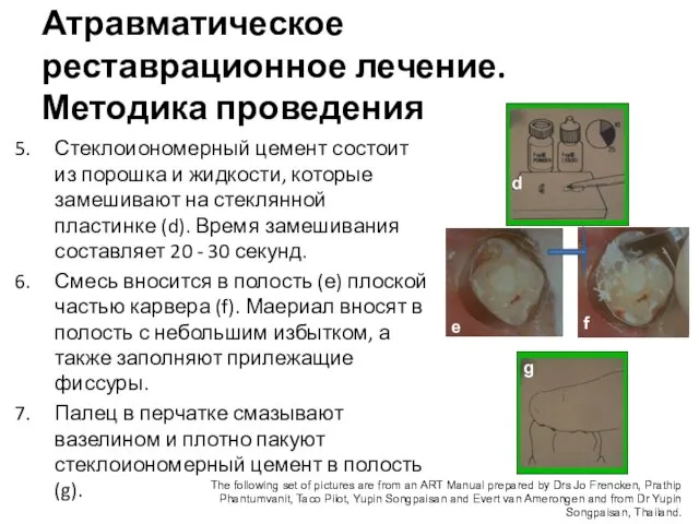 Стеклоиономерный цемент состоит из порошка и жидкости, которые замешивают на стеклянной