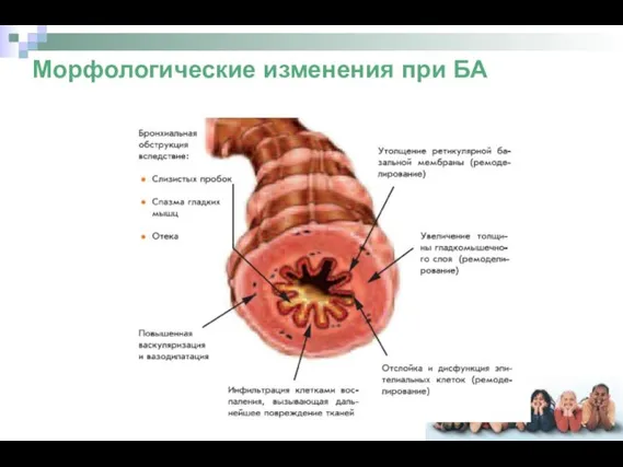 Морфологические изменения при БА