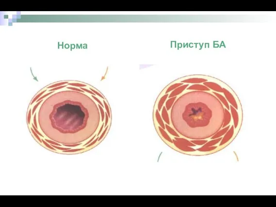 Норма Приступ БА