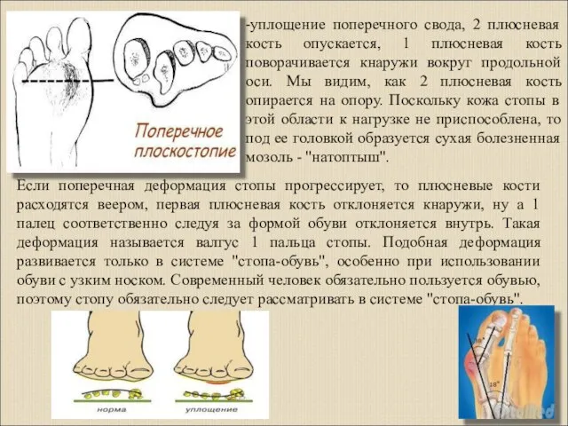 -уплощение поперечного свода, 2 плюсневая кость опускается, 1 плюсневая кость поворачивается