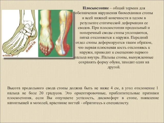 Плоскостопие – общий термин для обозначения нарушения биомеханики стопы и всей