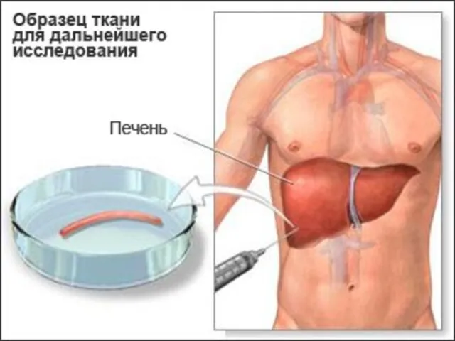 Аурудың өмірлік диагностикасындағы биопсияның маңызы. Биопсия (био және грек. opsіs —