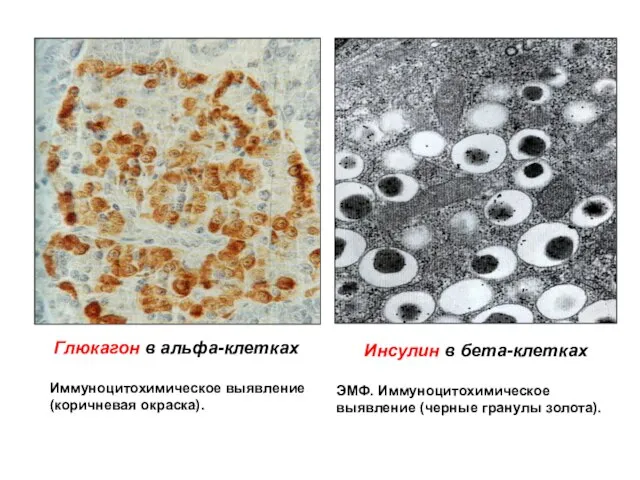 Инсулин в бета-клетках ЭМФ. Иммуноцитохимическое выявление (черные гранулы золота). Глюкагон в альфа-клетках Иммуноцитохимическое выявление (коричневая окраска).