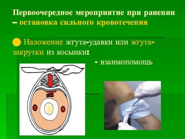 Первоочередное мероприятие при ранении – остановка сильного кровотечения ⬤ Наложение жгута-удавки