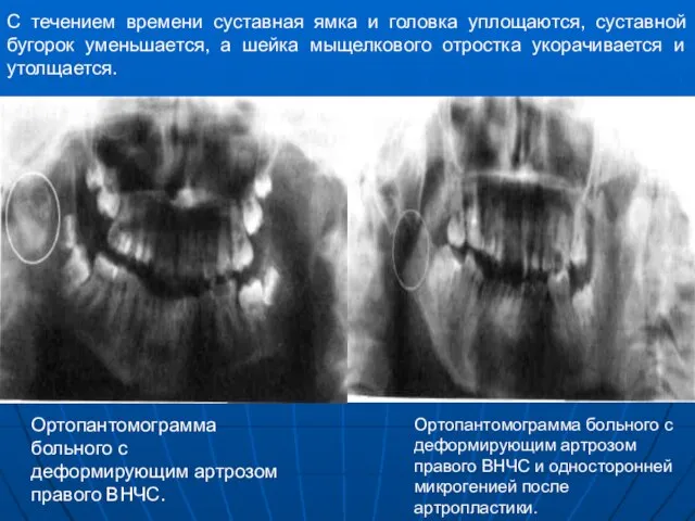 С течением времени суставная ямка и головка уплощаются, суставной бугорок уменьшается,