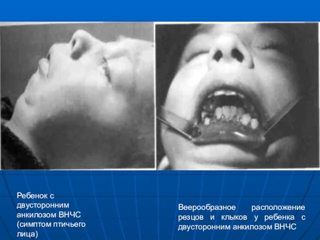 Ребенок с двусторонним анкило­зом ВНЧС (симптом птичьего лица) Веерообразное расположение резцов