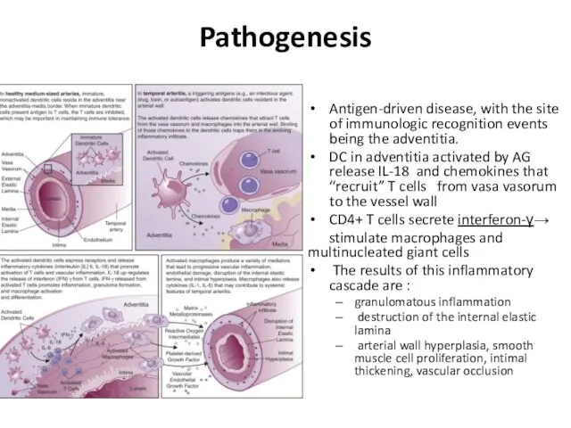 Pathogenesis Antigen-driven disease, with the site of immunologic recognition events being