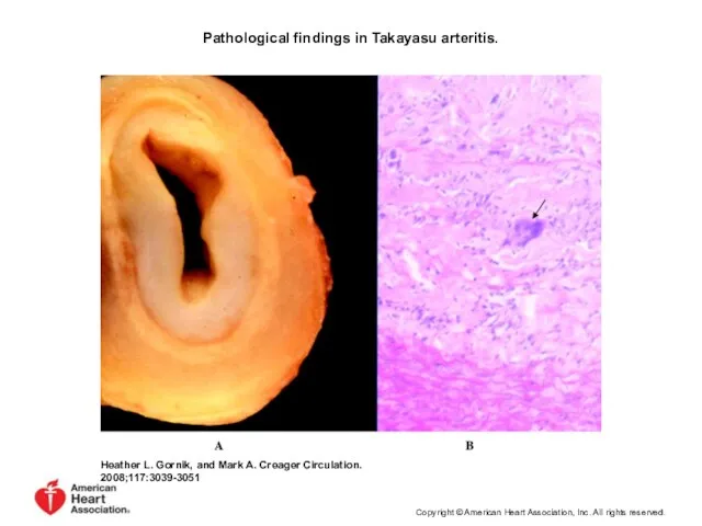 Pathological findings in Takayasu arteritis. Heather L. Gornik, and Mark A.