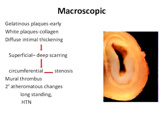 Macroscopic Gelatinous plaques-early White plaques-collagen Diffuse intimal thickening Superficial– deep scarring