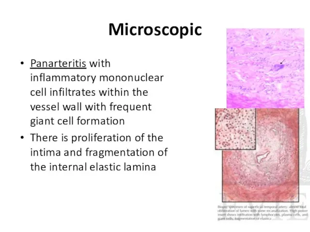 Microscopic Panarteritis with inflammatory mononuclear cell infiltrates within the vessel wall