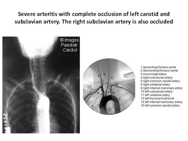 Severe arteritis with complete occlusion of left carotid and subclavian artery.