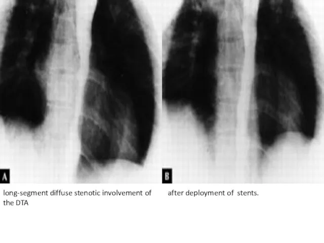 long-segment diffuse stenotic involvement of the DTA after deployment of stents.