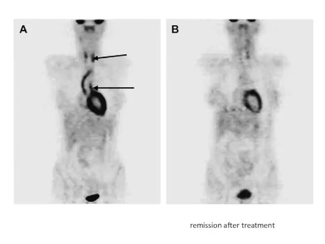 remission after treatment