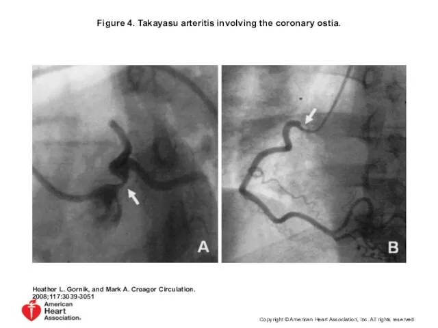 Figure 4. Takayasu arteritis involving the coronary ostia. Heather L. Gornik,