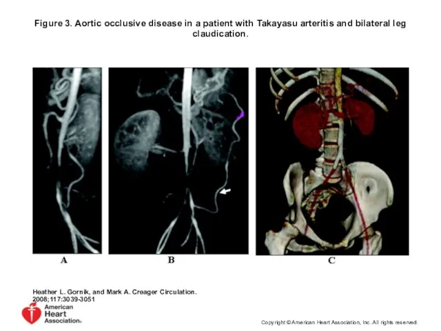 Figure 3. Aortic occlusive disease in a patient with Takayasu arteritis