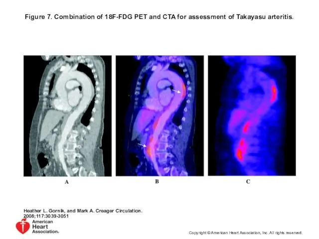 Figure 7. Combination of 18F-FDG PET and CTA for assessment of