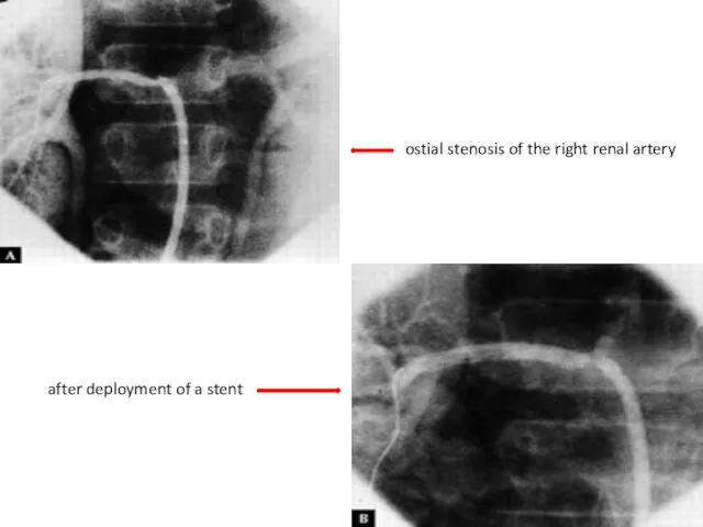 ostial stenosis of the right renal artery after deployment of a stent