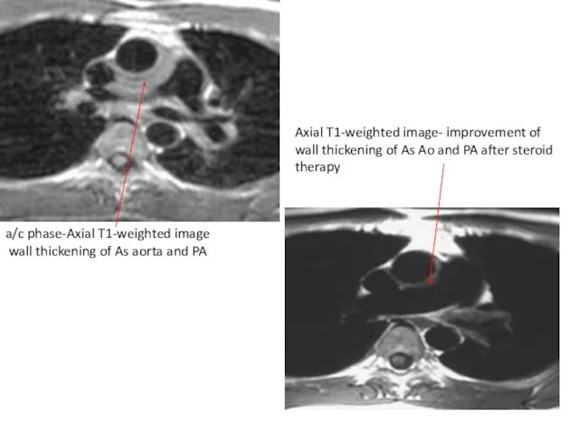 a/c phase-Axial T1-weighted image wall thickening of As aorta and PA