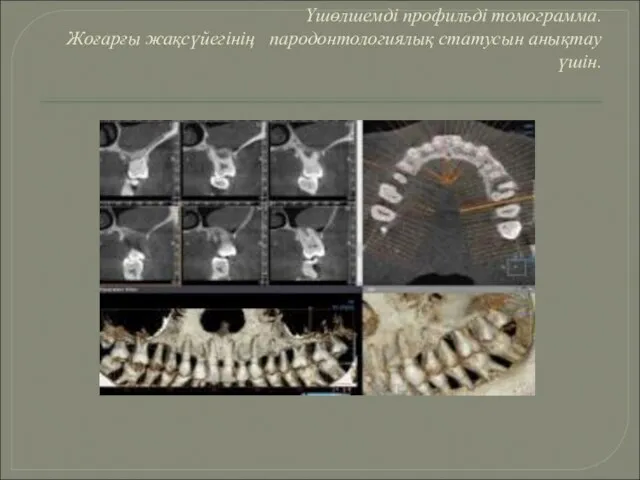 Үшөлшемді профильді томограмма. Жоғарғы жақсүйегінің пародонтологиялық статусын анықтау үшін.