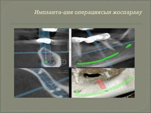 Импланта-ция операциясын жоспарлау