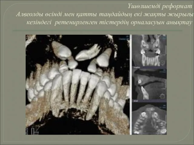 Үшөлшемді реформат Алвеолды өсінді мен қатты таңдайдың екі жақты жырығы кезіндегі ретенирленген тістердің орналасуын анықтау