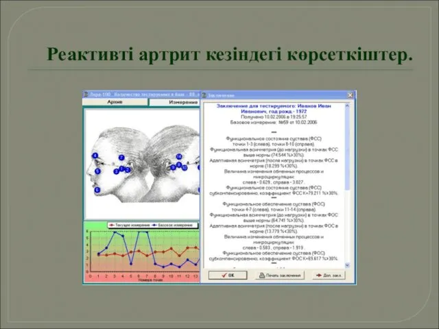 Реактивті артрит кезіндегі көрсеткіштер.