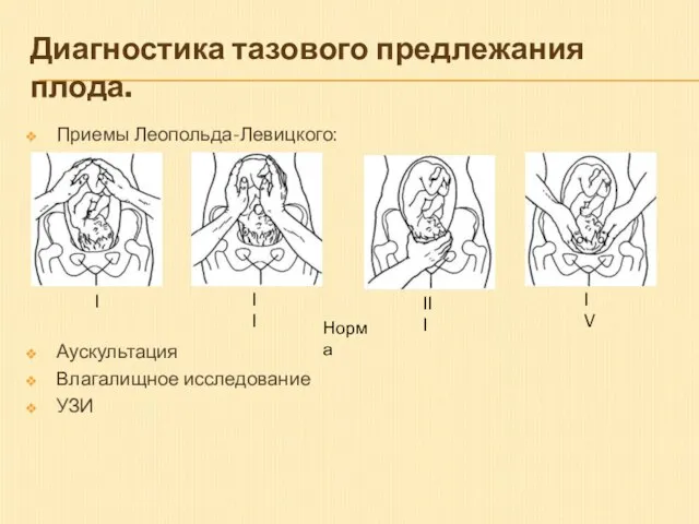 Диагностика тазового предлежания плода. Приемы Леопольда-Левицкого: Аускультация Влагалищное исследование УЗИ Норма I II III IV