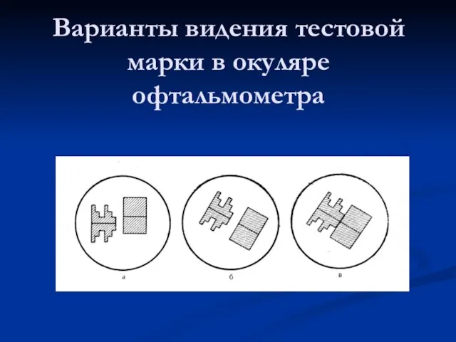 Варианты видения тестовой марки в окуляре офтальмометра