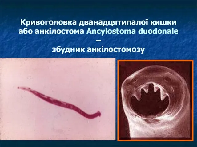 Кривоголовка дванадцятипалої кишки або анкілостома Ancylostoma duodonale – збудник анкілостомозу