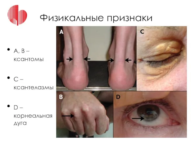 Физикальные признаки А, В – ксантомы С – ксантелазмы D – корнеальная дуга